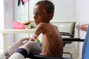Yemen’s children starve amid rising fears of famine