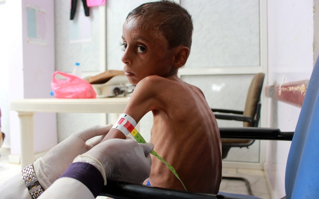 Yemen’s children starve amid rising fears of famine